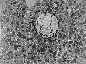 M,3y. | normal hepatocyte